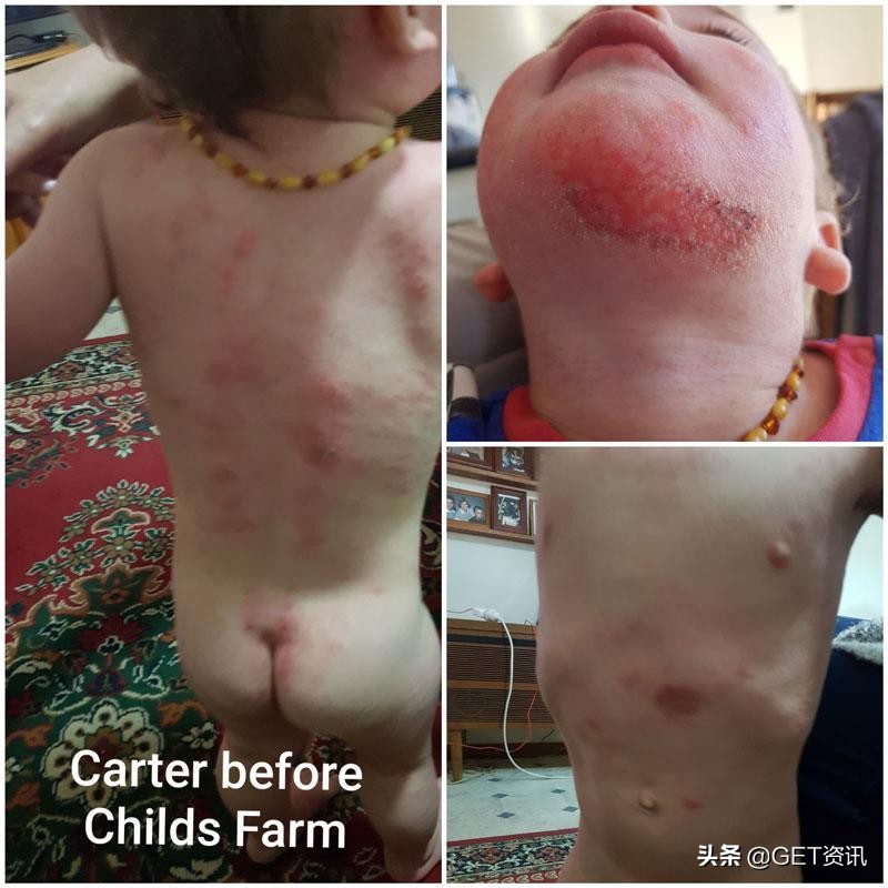 澳洲婴幼儿湿疹,澳洲小孩湿疹