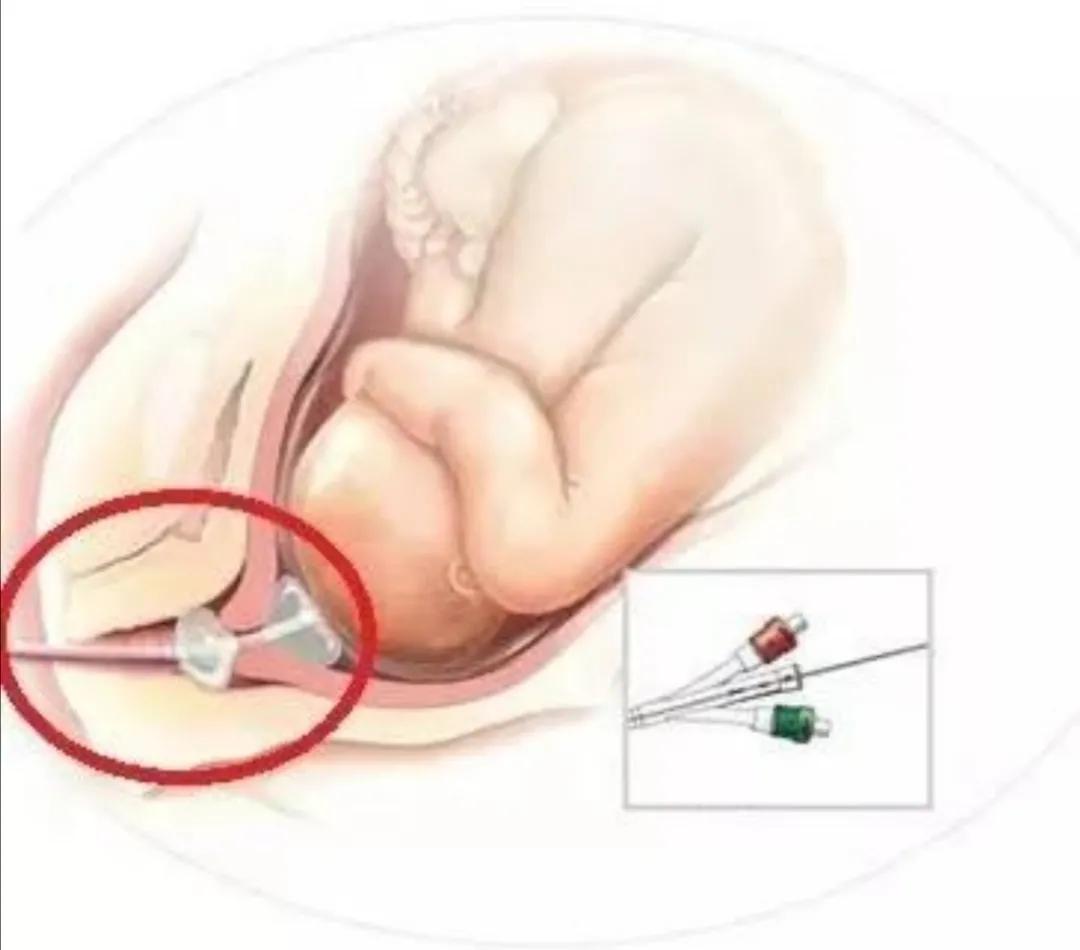 孕39周加5需要去医院待产吗,39周住院待产3天了还没反应视频