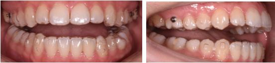 隐形牙套矫正和钢牙矫正哪个好,隐形牙齿矫正牙套种类