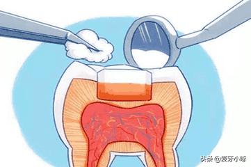 牙齿有黑洞必须修复吗,牙齿有黑洞也不能嚼东西怎么办