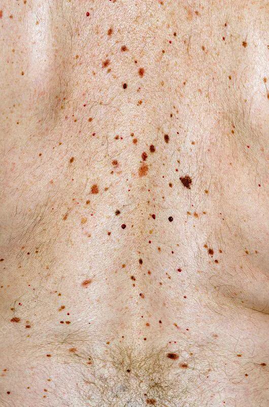 乙肝患者皮肤发黄还意味着什么,乙肝患者皮肤出现红点