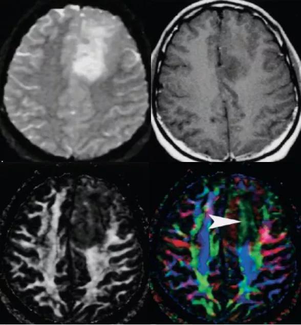 磁共振dti融合成像,磁共振dti成像作用
