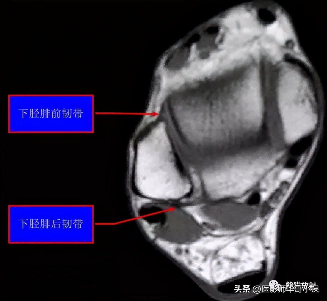 踝关节解剖视频课,解剖学韧带分布图