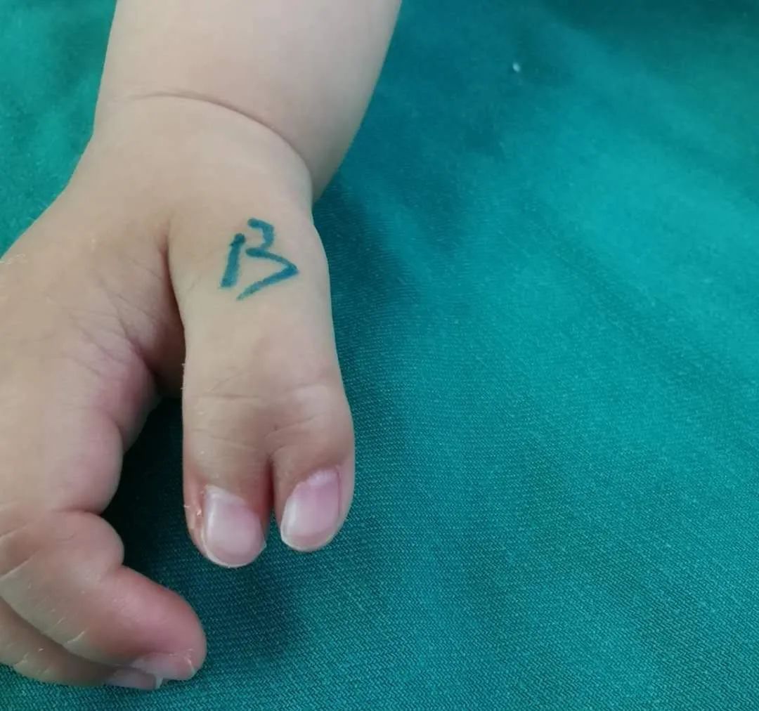 孩子出现多指畸形该怎么办,宝宝脚趾畸形多指最佳治疗时间