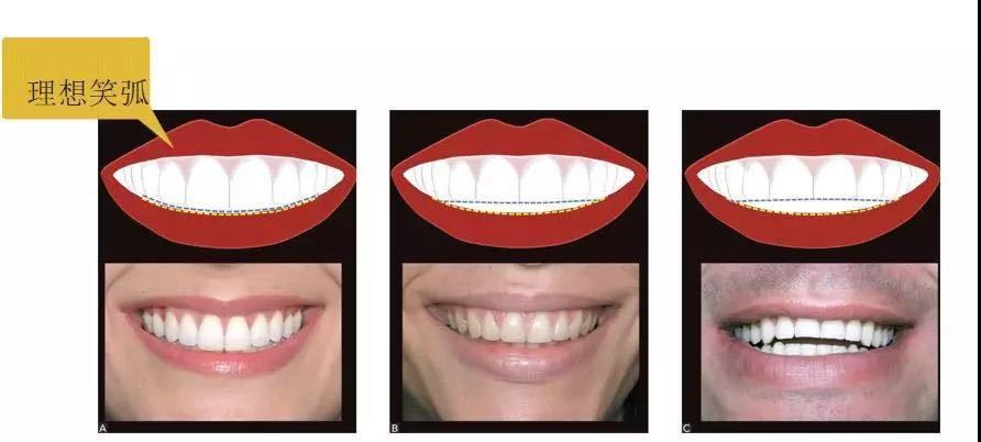 牙齿美学修复的缺点,大龄牙齿矫正经历和感受