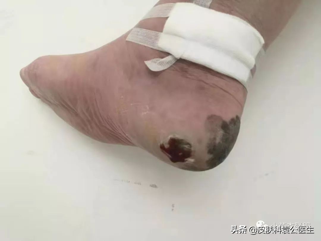 痣边缘模糊图片,痣长多大会变成黑色素瘤