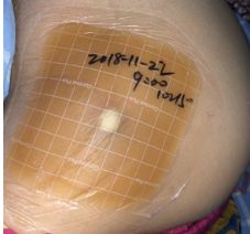 压疮敷料的选择及使用,褥疮敷料的正确使用方法