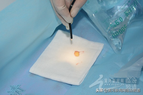 气管镜下异物取出术案例分析,支气管镜取出异物视频