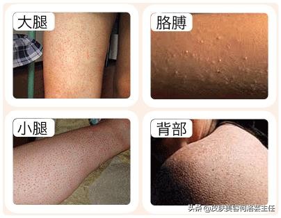 摆脱鸡皮肤的困扰,去鸡皮肤有效的方法真实测评