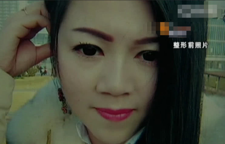 女子鼻子整容失败,女子鼻子整形