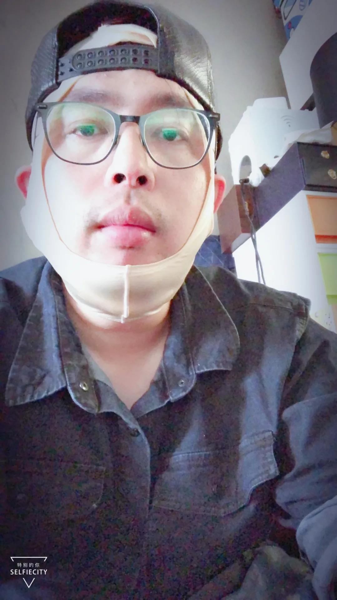 抽脂亲身经历回忆,抽脂血泪史