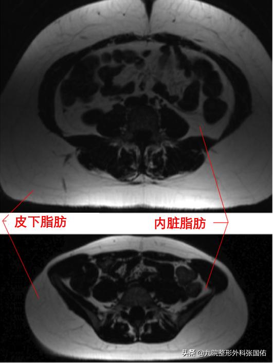 肥胖型大肚子的表现,肥胖大肚子是怎么引起的