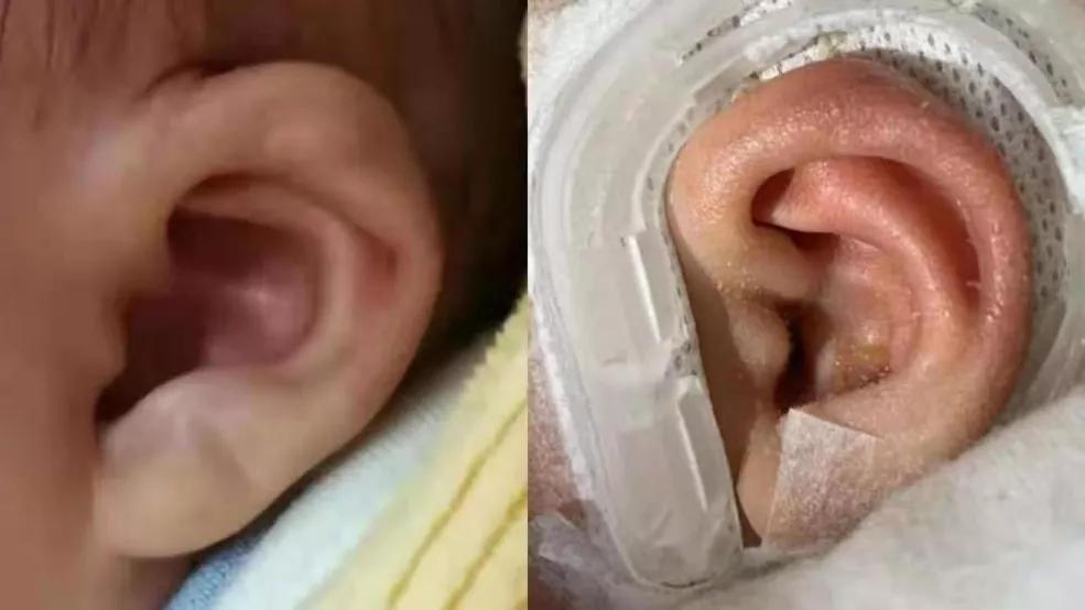 新生儿耳廓畸形需要抹什么药定型,新生儿耳朵轮廓畸形家长怎么办