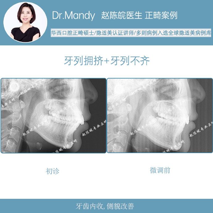 隐适美隐形矫正成功案例,经典隐形矫正