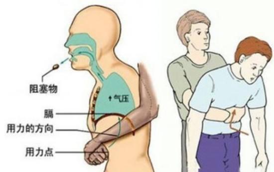 3岁小孩误吞一整颗花生怎么办,一岁宝宝误吞一颗花生米怎么办