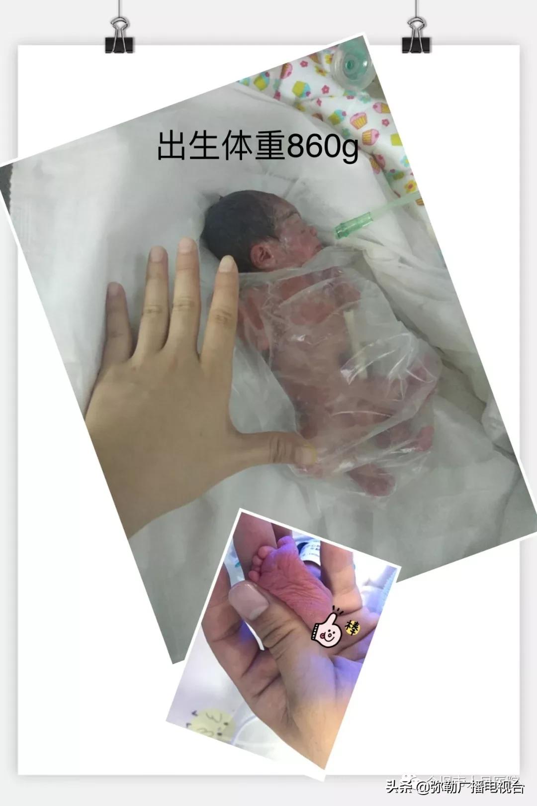 600克袖珍婴儿出院,860克早产女婴