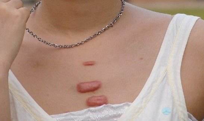 疤痕疙瘩是不是全都建议切除呢？疤痕疙瘩治疗方法