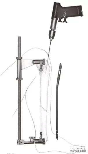 髓内钉技巧,髓内钉教学视频讲解