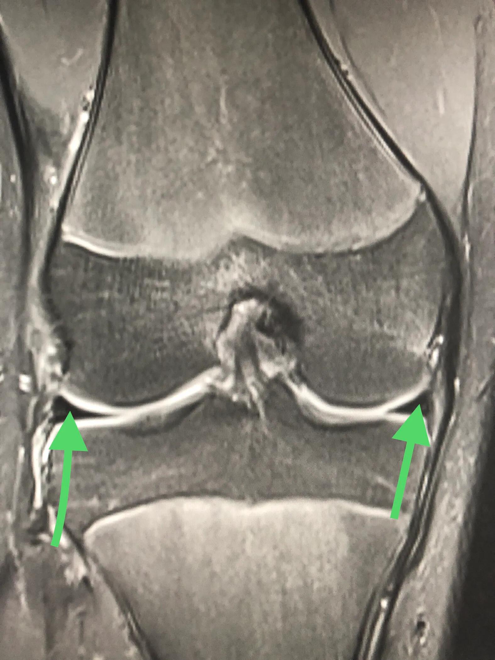 小构件大问题的膝关节半月板