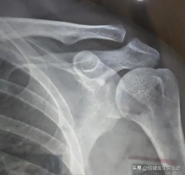 胳膊一动胸椎就咯噔咯噔响,肩锁关节脱位需要吊胳膊吗