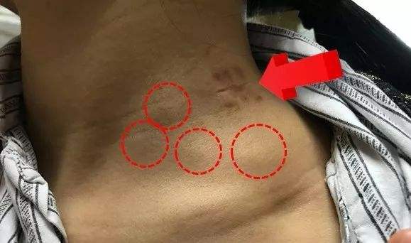 淋巴排毒属于虚假宣传吗,淋巴排毒自我按摩辟谣