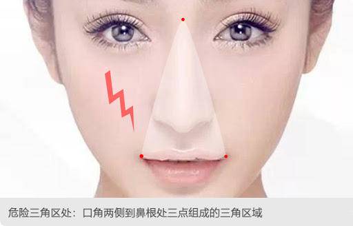 挤痘痘后怎么预防颅内感染,女孩挤痘引发颅内感染新闻