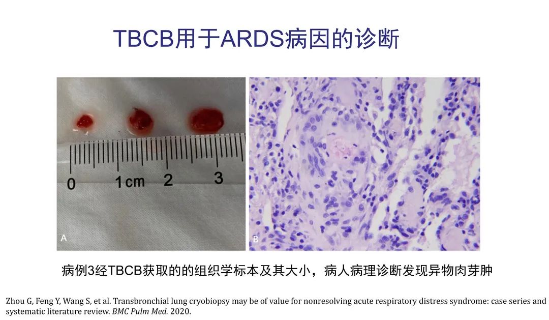 经皮肺穿刺活检术过程,经支气管冷冻肺活检