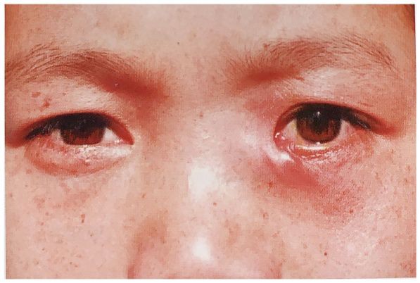 慢性泪囊炎用什么眼药水好,慢性泪囊炎手术费多少钱