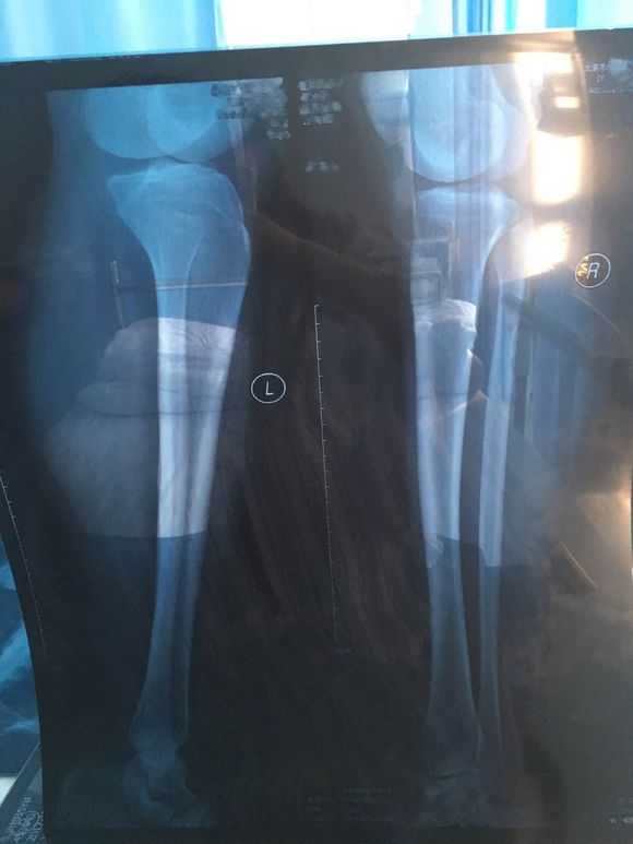 怎么从根本上解决o型腿,告别o型腿最快的方法