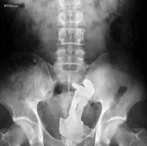 不作死就不会死,看看这些被人类搞进身体里的异物