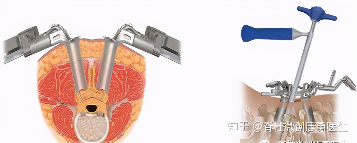 腰痛是不是肾肿瘤,腰痛要警惕腰椎间盘突出