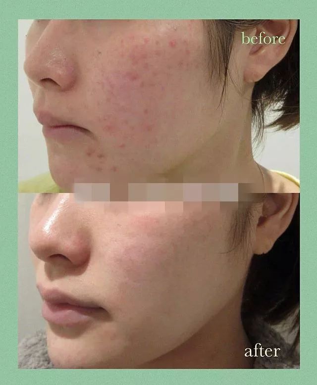 我用空瓶了几十瓶面霜的经验告诉你,谁才是真正的干皮亲妈