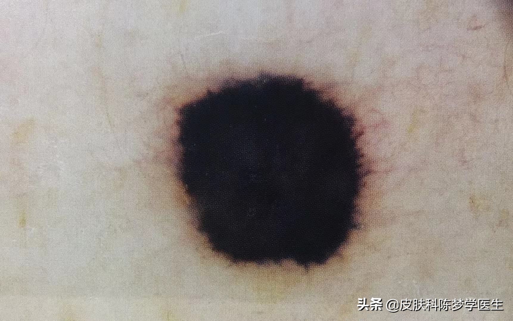 一次激光点痣会导致癌变吗,激光点痣会诱发痣癌变是真的吗