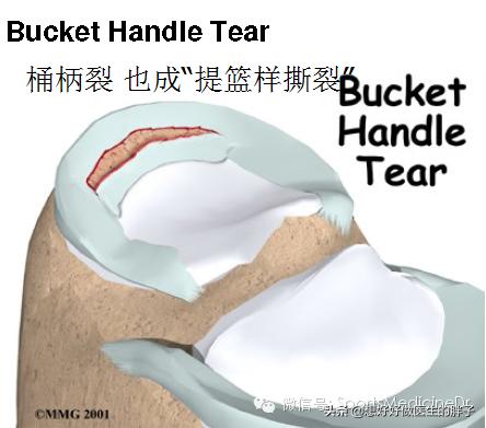 半月板损伤通常是单膝还是双膝,你知道半月板是什么吗