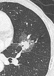 磨玻璃肺结节17mm要不要马上手术,7毫米肺磨玻璃结节要不要切除