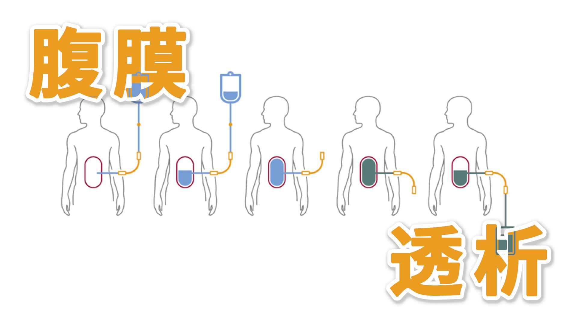 尿毒症的肾脏替代治疗方式,尿毒症替代治疗