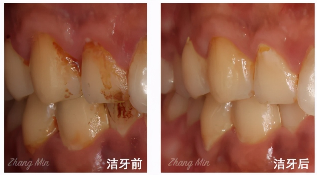 一口黄牙怎么办？10年牙科医生教你怎么拥有一口亮白美牙
