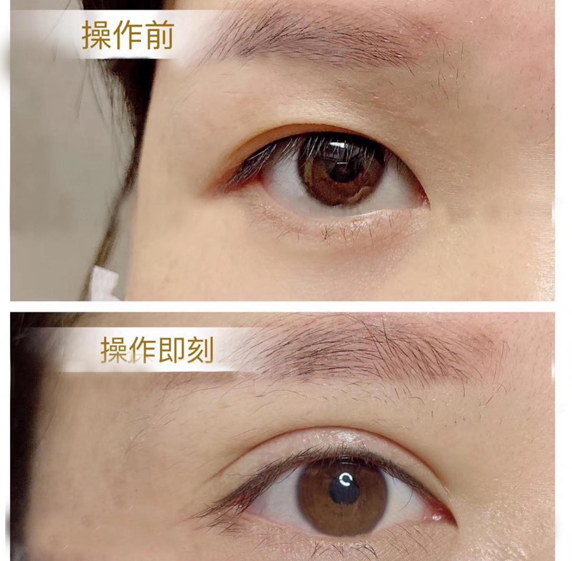 双眼皮手术睁眼闭眼效果,双眼皮手术怎么看着不假