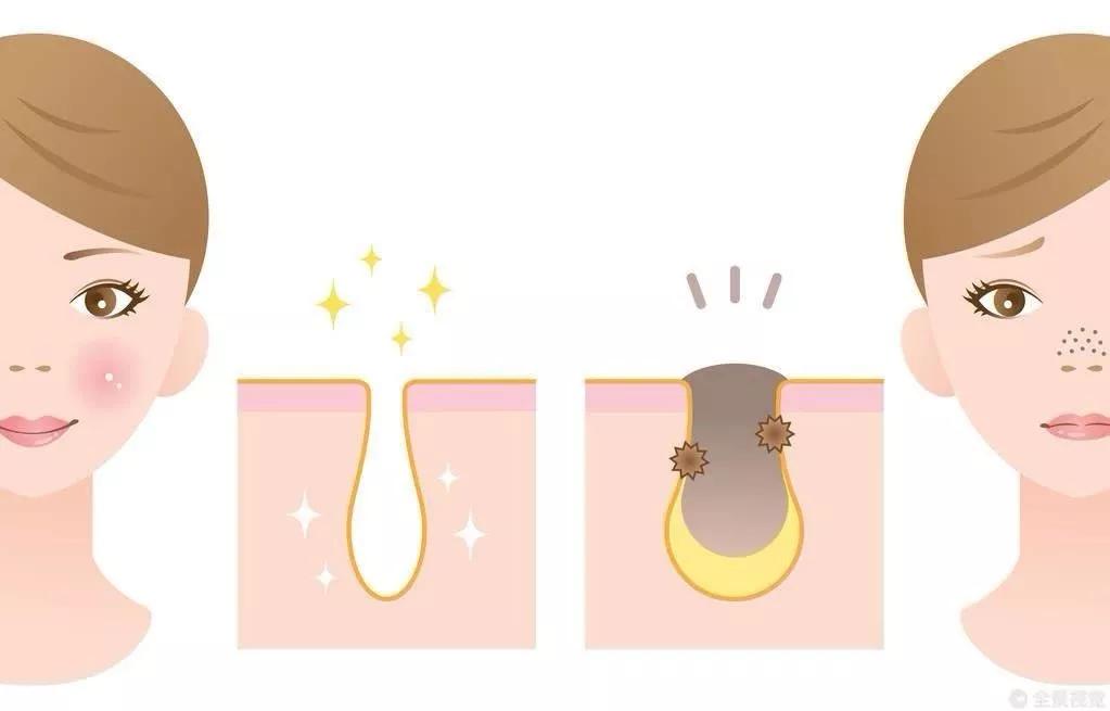 甲硝唑凝胶去痘印效果特别好,甲硝唑凝胶丘疹的正确使用方法