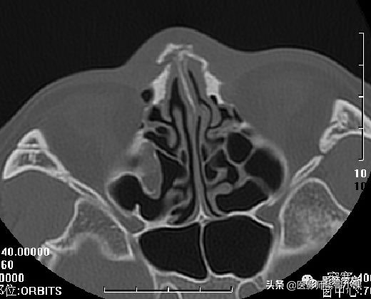 「鼻骨彩图」鼻骨CT解剖及骨折影像学诊断
