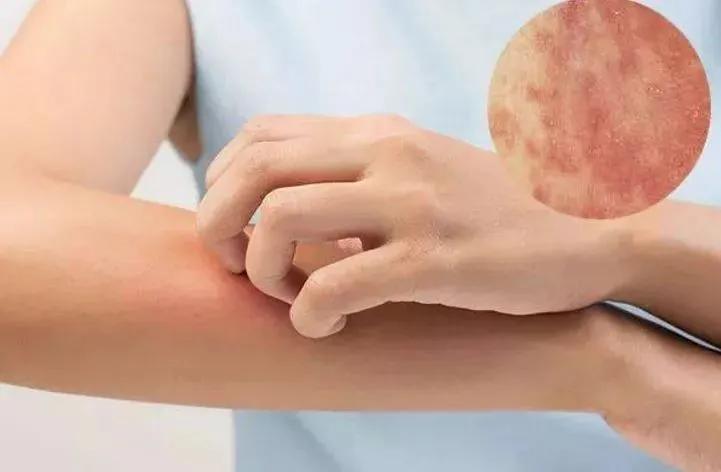 湿疹性皮炎最简单的自愈方法,全身都痒皮炎湿疹最好的治疗方法