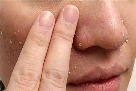 去黑头攻略：被黑头耽误的鼻子是该处理一下了