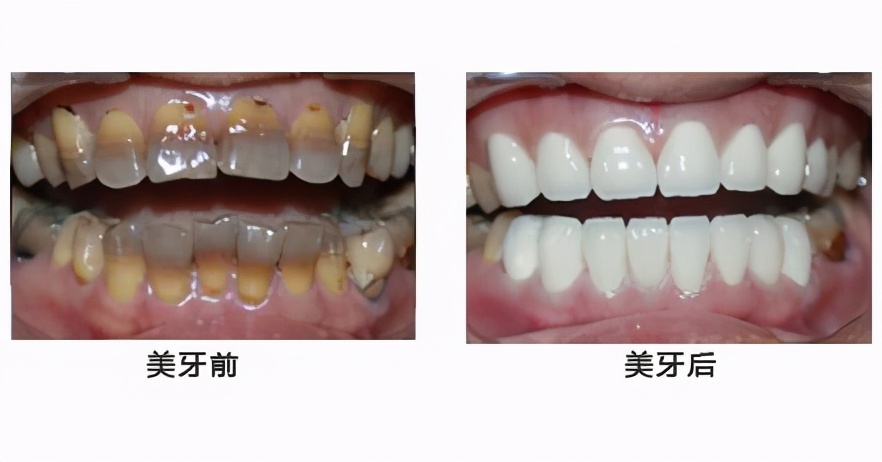 烤瓷牙导致的牙龈发黑能恢复吗,烤瓷牙脱落会造成哪些严重后果