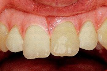 3岁小孩牙齿要怎么保护,儿童牙齿外伤需要检查什么