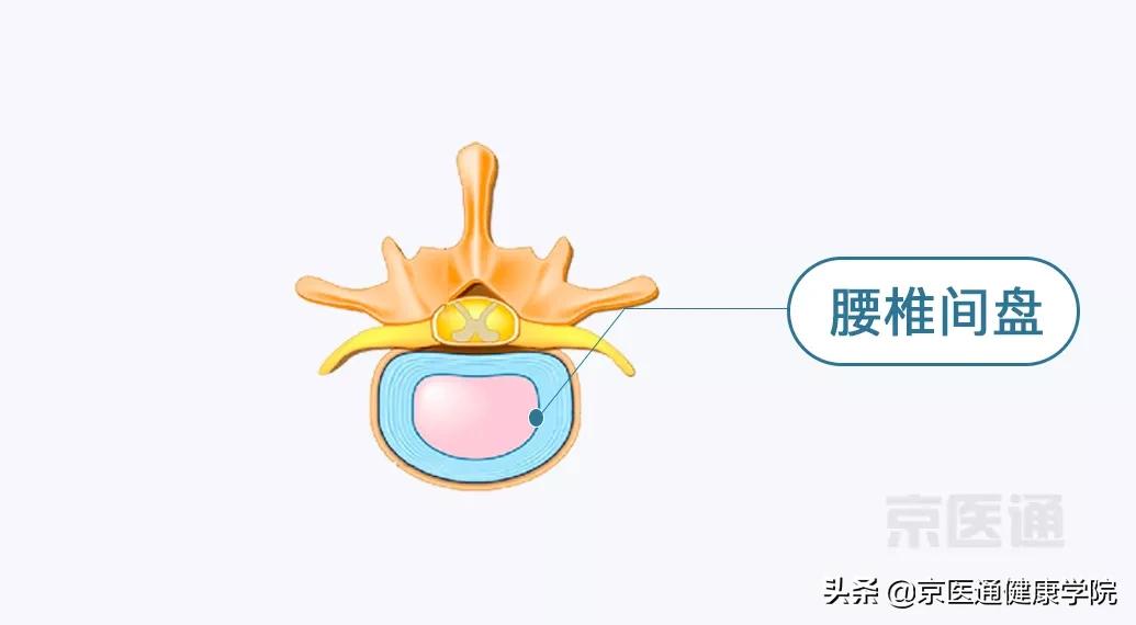 腰痛、腿痛是什么病？骨科医生用一块「羊蝎子」告诉你