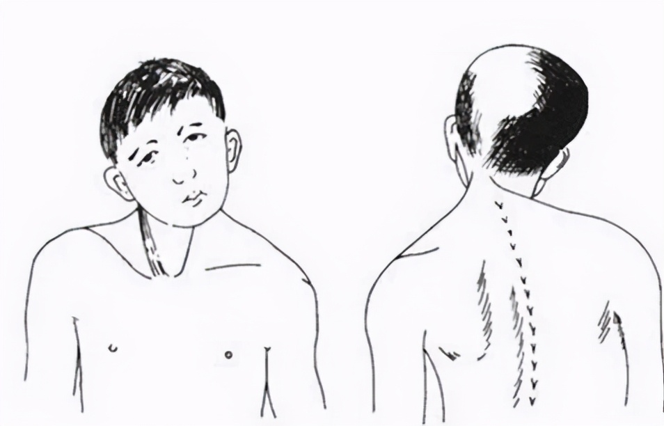 长期单边咀嚼后大小脸怎么恢复,单侧咀嚼大小脸可以恢复吗