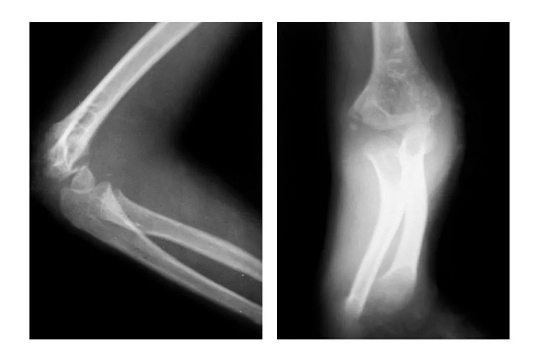 青少年肘部损伤最常见的是,肘部桡神经损伤的临床表现