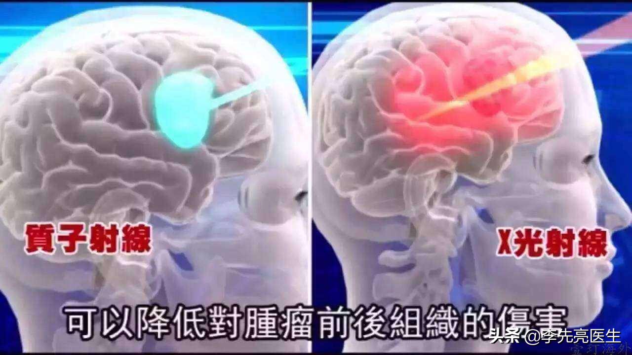 质子重离子能治癌转移吗,治癌利器质子重离子