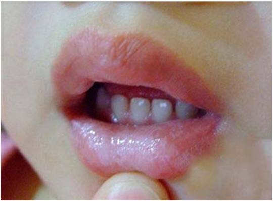 宝宝嘴里有白色的小点叫什么,一个月宝宝口腔上颚白色的是什么