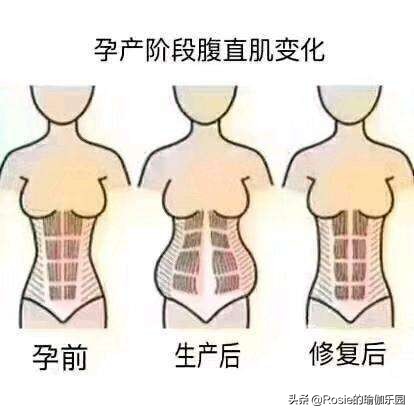 肋骨外翻怎么改善回来,肋骨外翻改善法